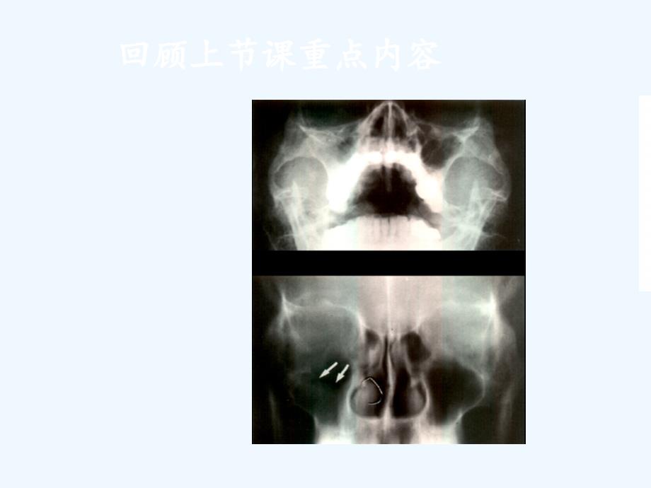 X线检查与诊断技术第四篇胸部一课件_第3页