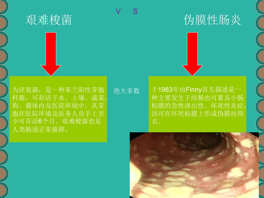 抗生素相关性艰难梭菌伪膜性肠炎_第2页