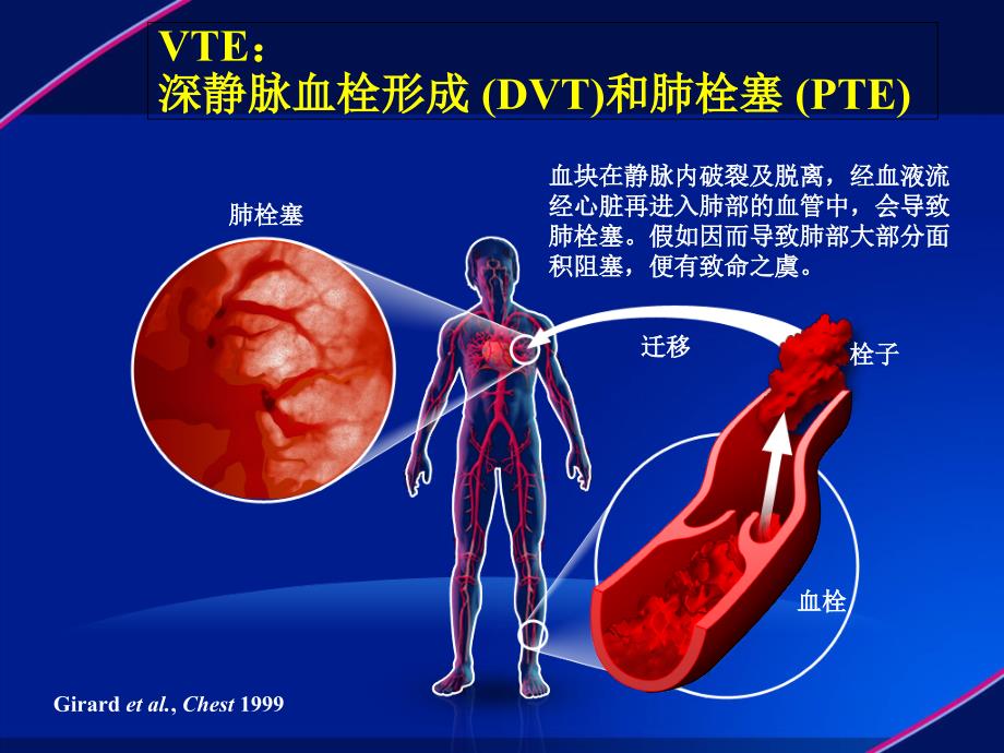 静脉血栓(VTE)防治解读PPT课件_第3页