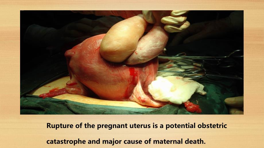 子宫破裂 PPT课件.ppt_第2页