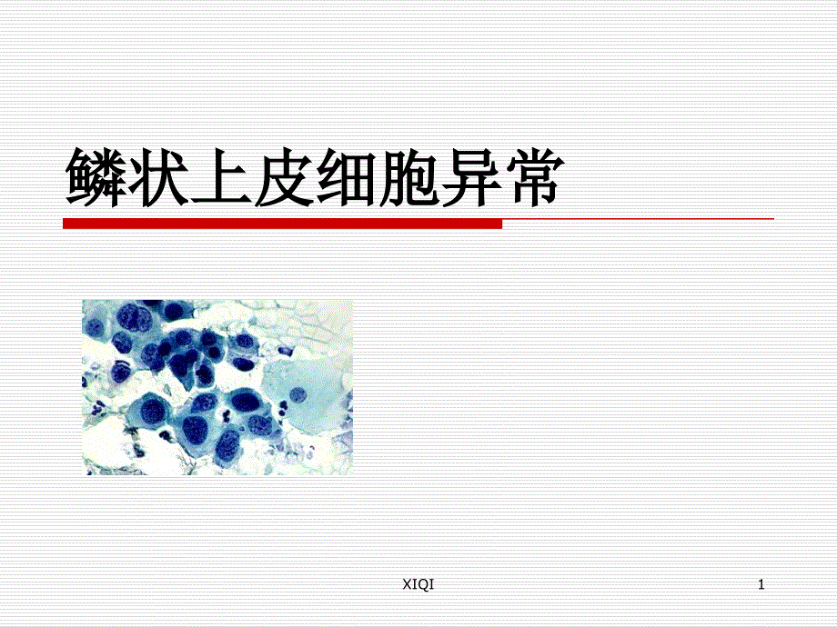 鳞状上皮细胞异常_第1页