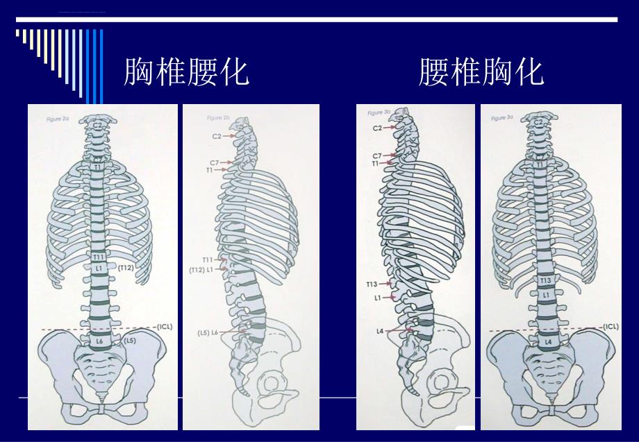 脊柱侧弯基础知识ppt课件_第4页