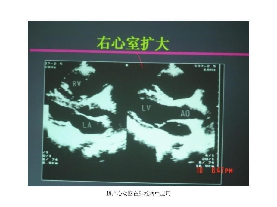 超声心动图在肺栓塞中应用课件_第5页