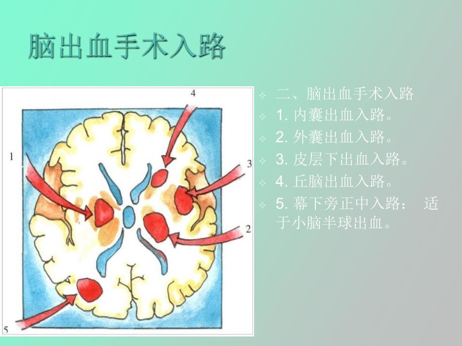 神经外科手术入路_第2页