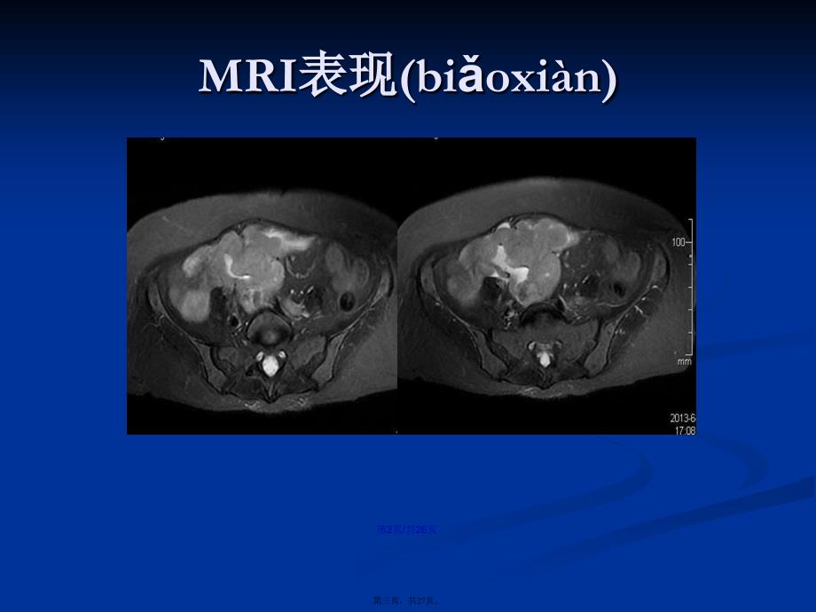 MRI疑难病例讨论学习教案_第3页