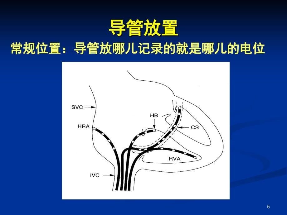 如何看懂腔内心电图课堂PPT_第5页