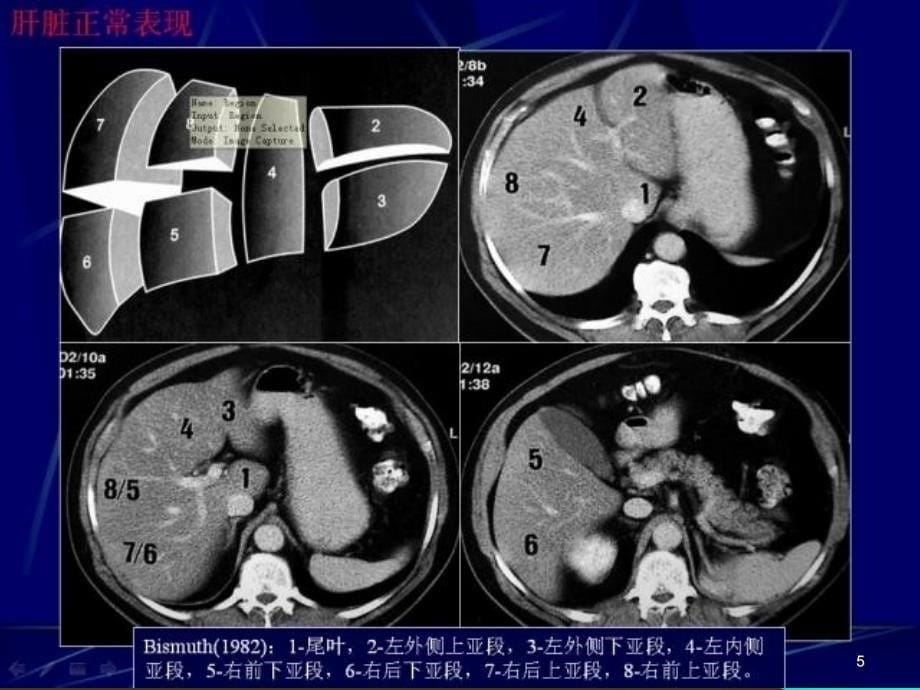 肝癌影像学表现ppt课件_第5页