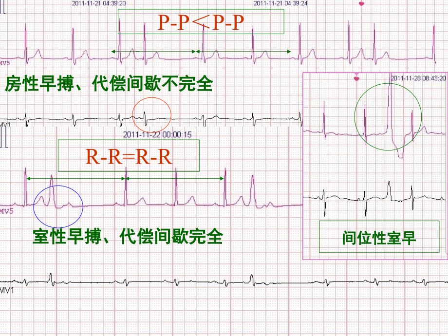 心电图讲课ppt课件_第3页