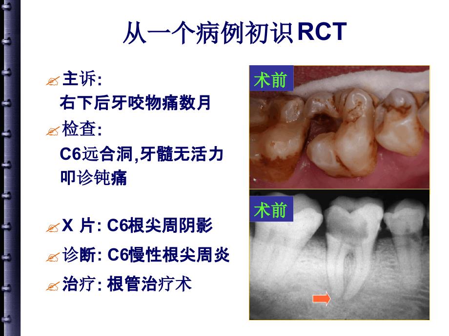 根管治疗的步骤方法器械课件_第4页