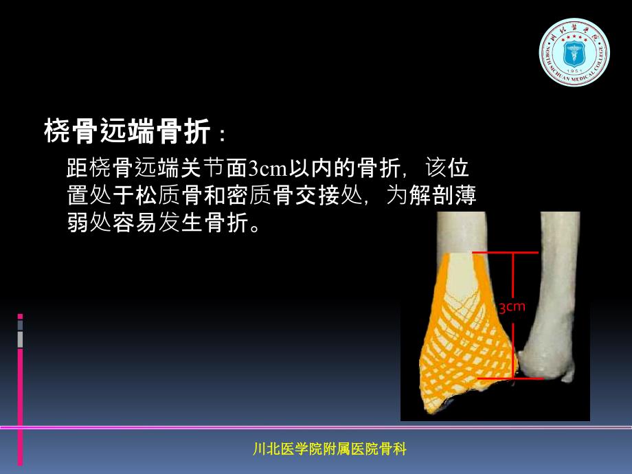 掌背侧钢板治疗桡骨远端骨折课件_第2页