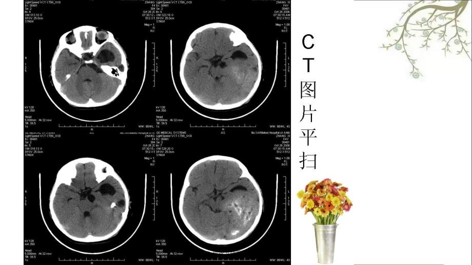 神经节细胞胶质瘤课件_第2页