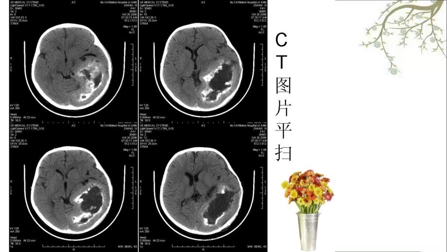 神经节细胞胶质瘤课件_第3页