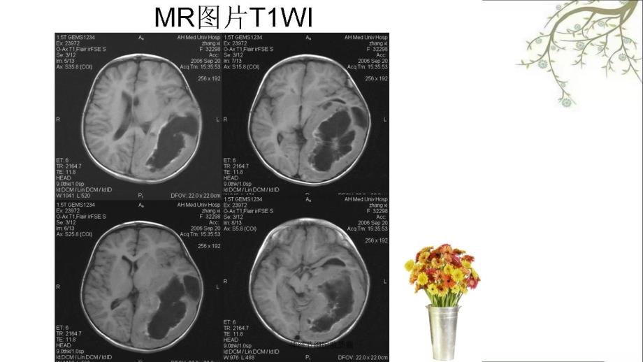 神经节细胞胶质瘤课件_第4页