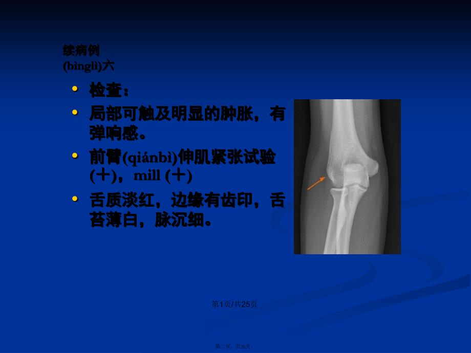 肱骨外上髁炎骨伤学习教案_第2页