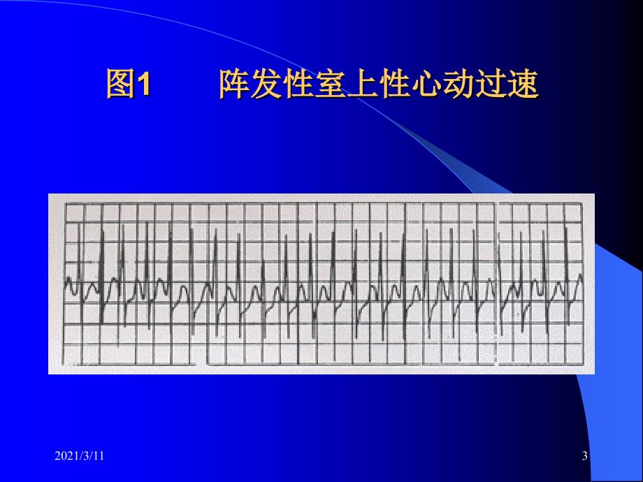 严重心律失常的诊断和急救处理_第3页