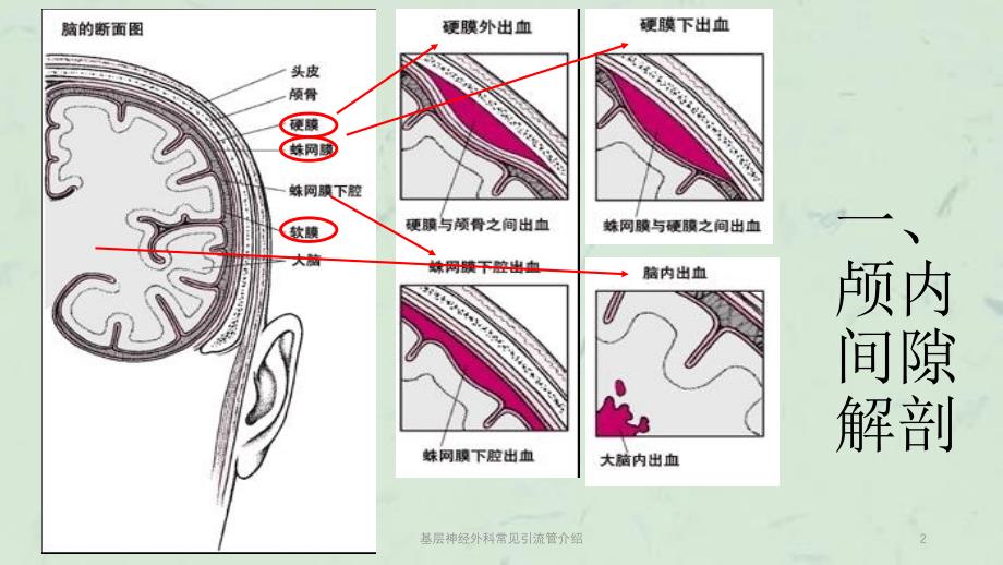 基层神经外科常见引流管介绍课件_第2页