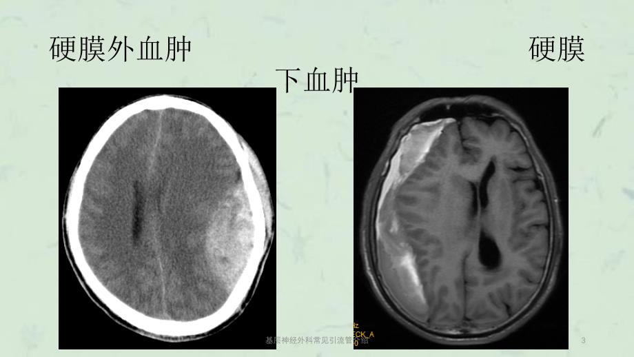 基层神经外科常见引流管介绍课件_第3页