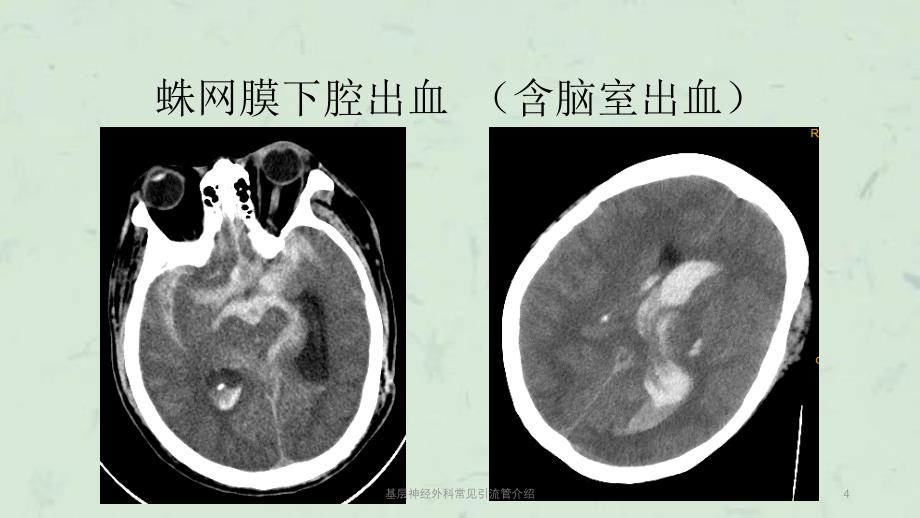 基层神经外科常见引流管介绍课件_第4页