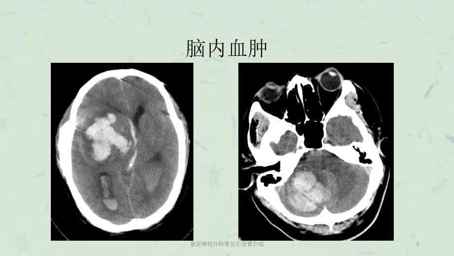 基层神经外科常见引流管介绍课件_第5页