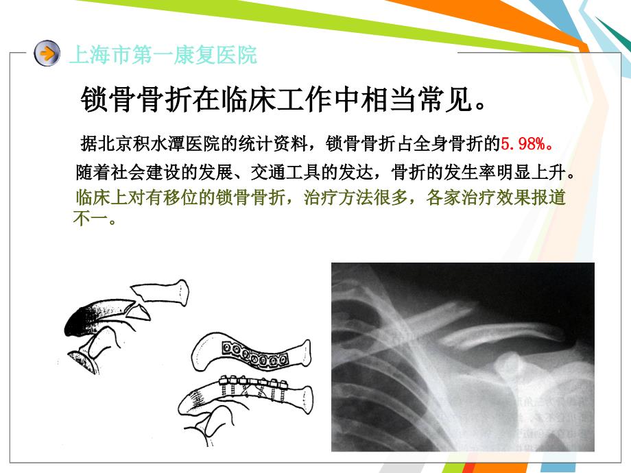 锁骨骨折内固定PPT课件_第2页