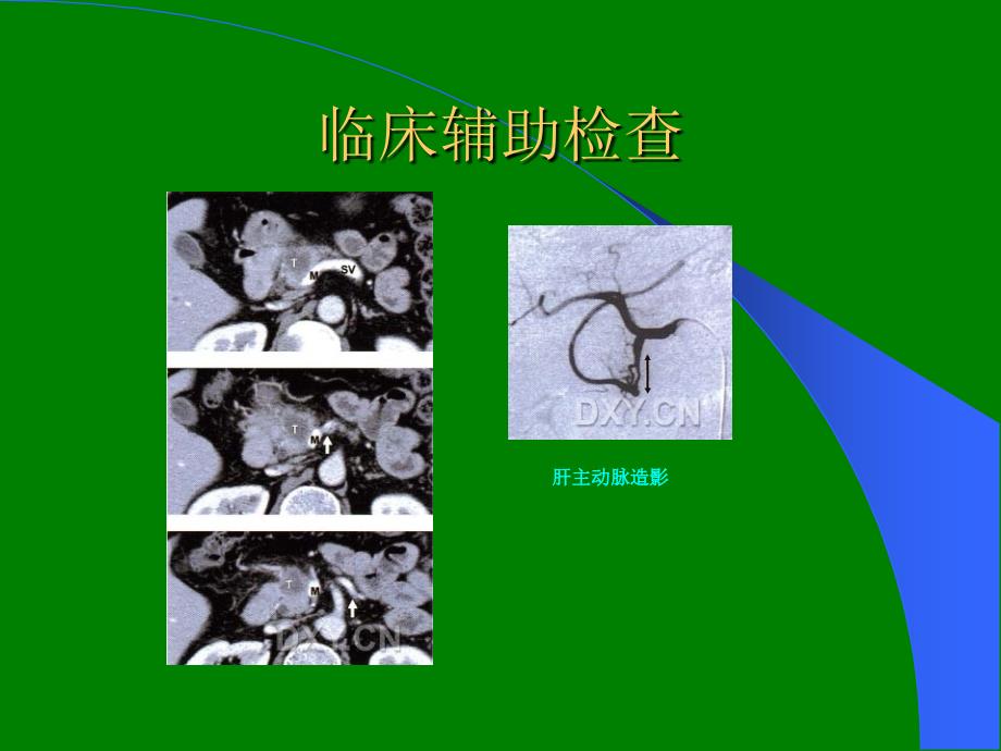 胰十二指肠切除术ppt课件_第4页