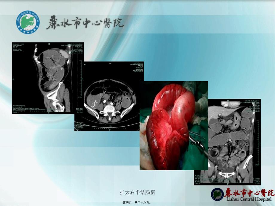 扩大右半结肠新课件_第4页