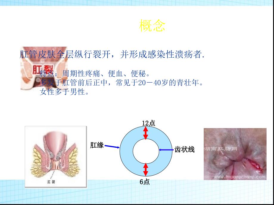 肛裂PPT演示课件_第3页