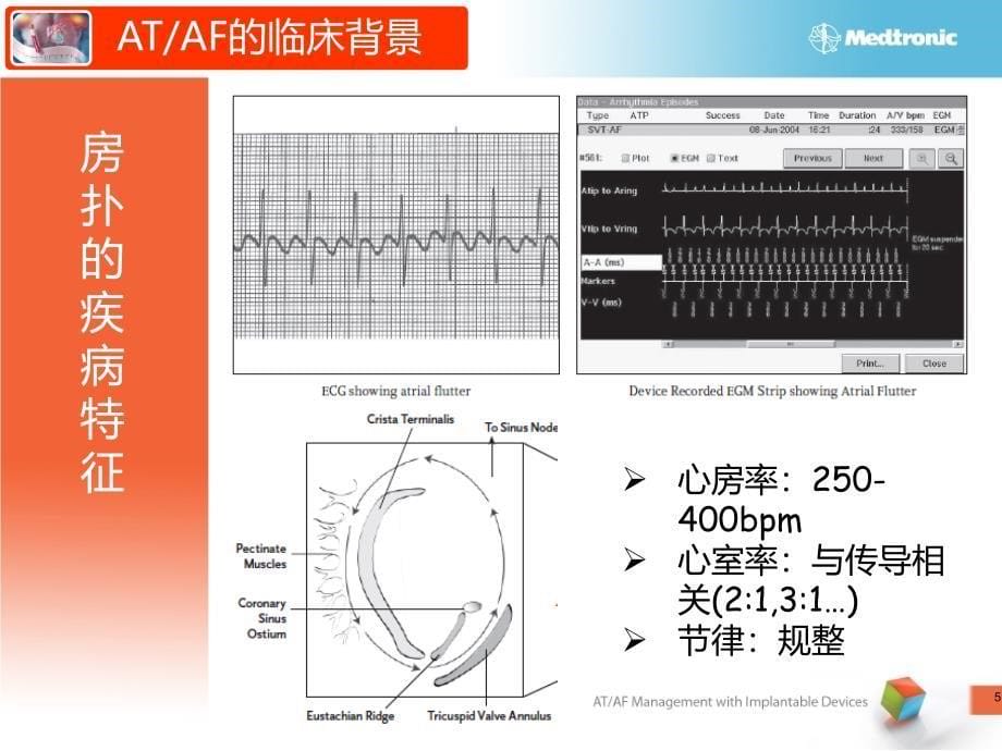 起搏器课件：起搏患者的ATAF管理_第5页