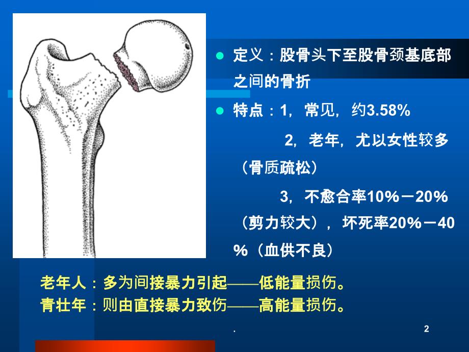 股骨颈骨折治疗选择PPT课件_第2页