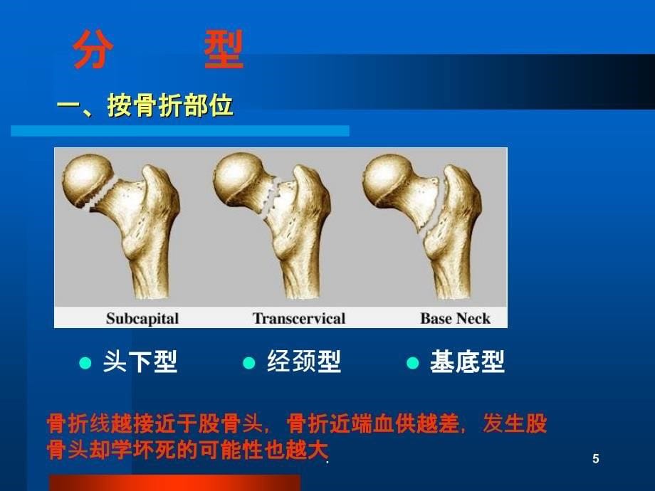 股骨颈骨折治疗选择PPT课件_第5页