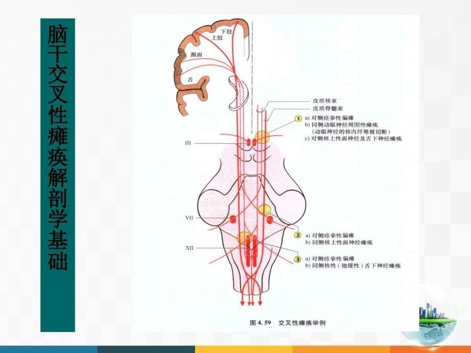 脑干病变综合征课件_第5页