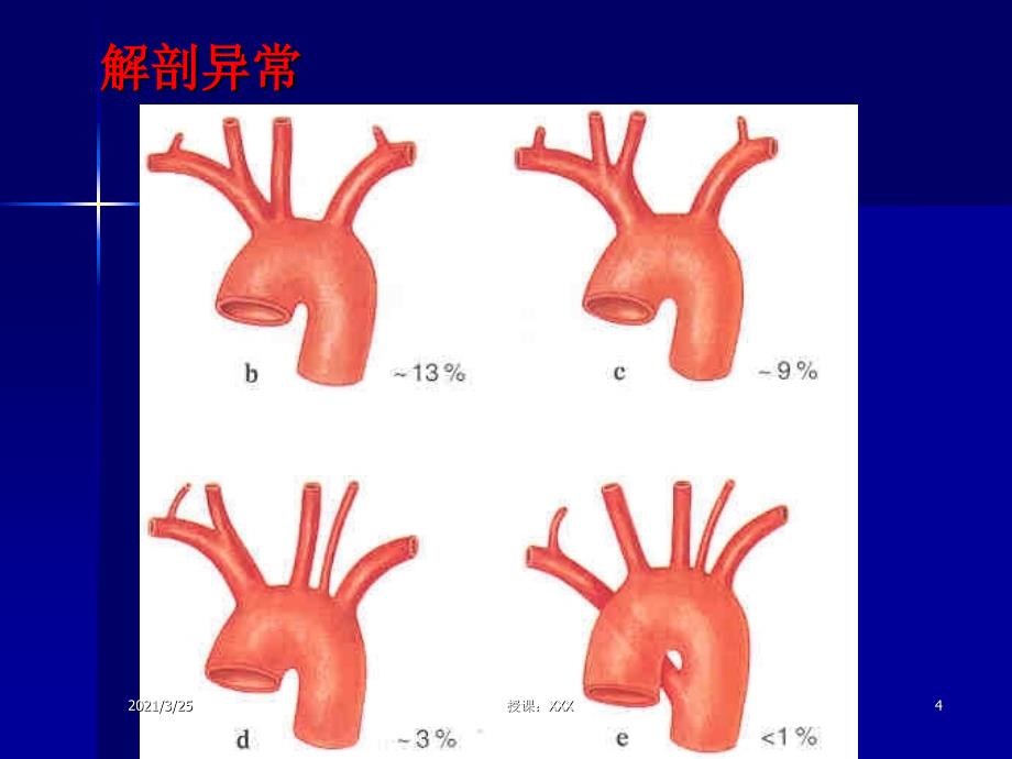 主动脉夹层及腹主动脉瘤CTA影像PPT课件_第4页