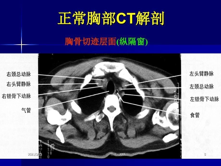 主动脉夹层及腹主动脉瘤CTA影像PPT课件_第5页