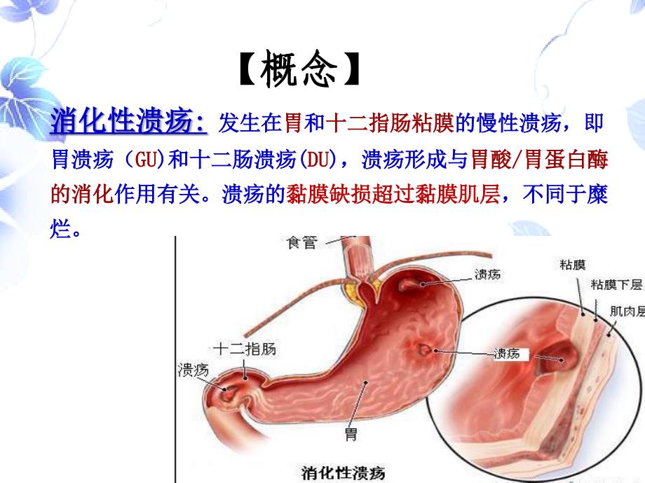 消化性溃疡的护理_第2页