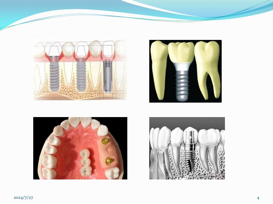 种植义齿概述ppt参考课件_第4页