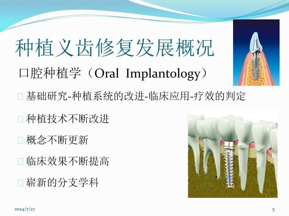 种植义齿概述ppt参考课件_第5页