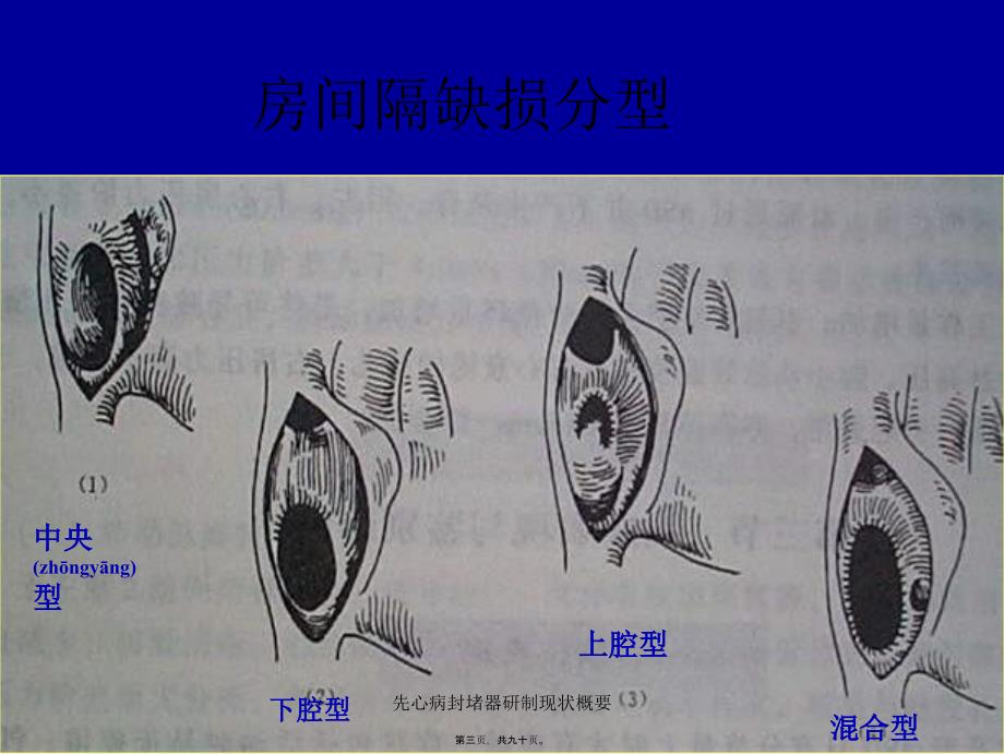 先心病封堵器研制现状概要课件_第3页