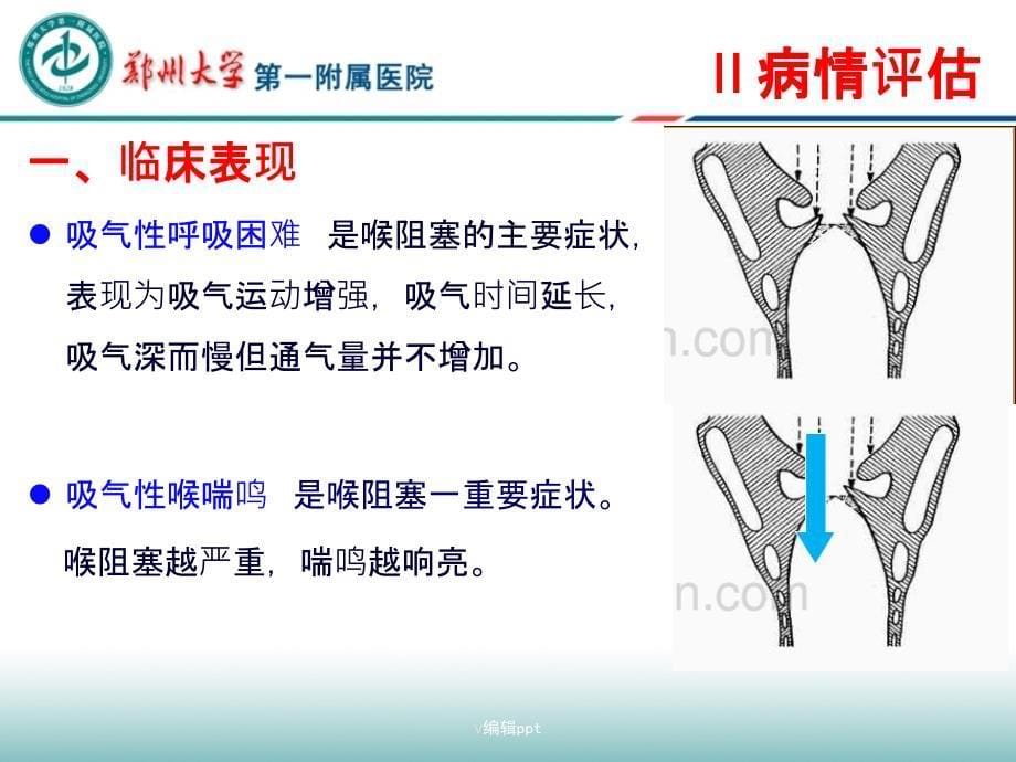 喉阻塞的护理_第5页