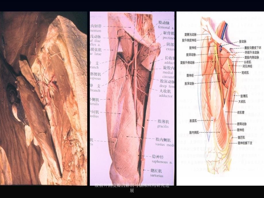 股前外侧皮瓣的解剖与临床应用研究进展课件_第5页