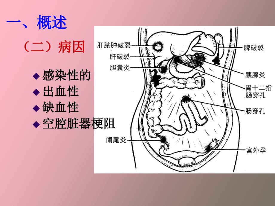 外科护理学急腹症_第4页