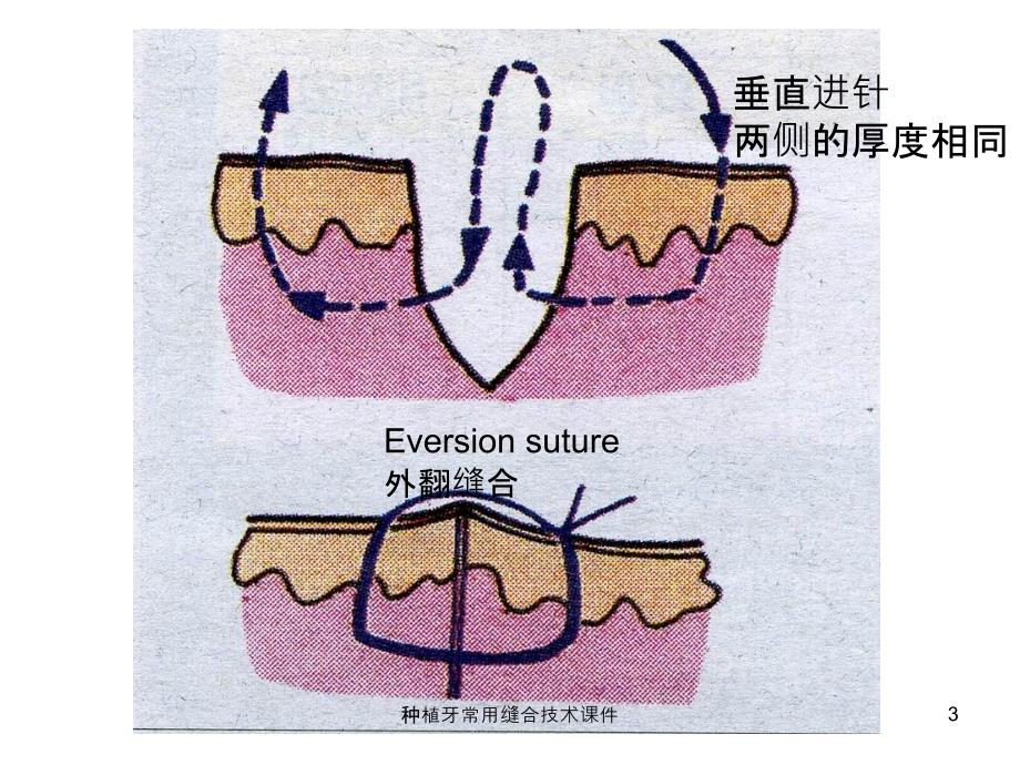 种植牙常用缝合技术课件_第3页