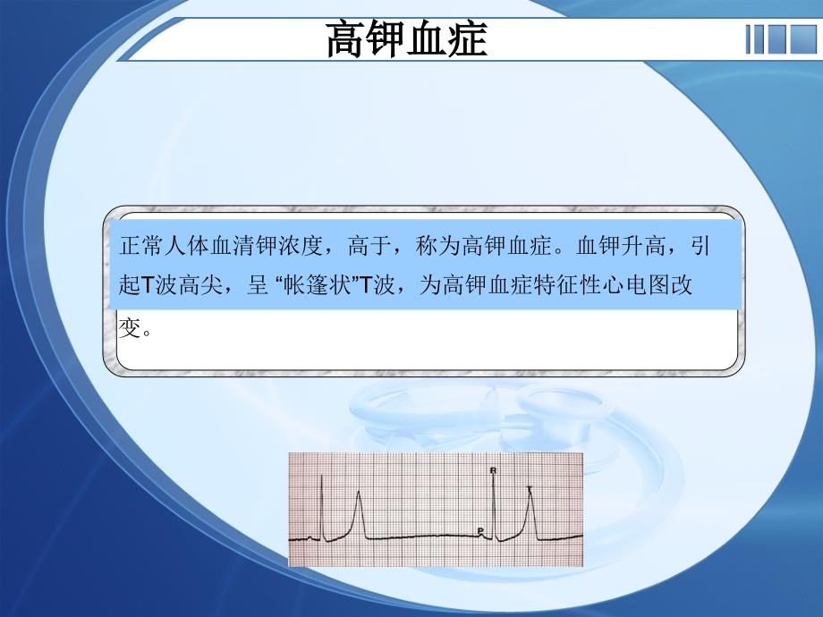 电解质紊乱心电图_第2页