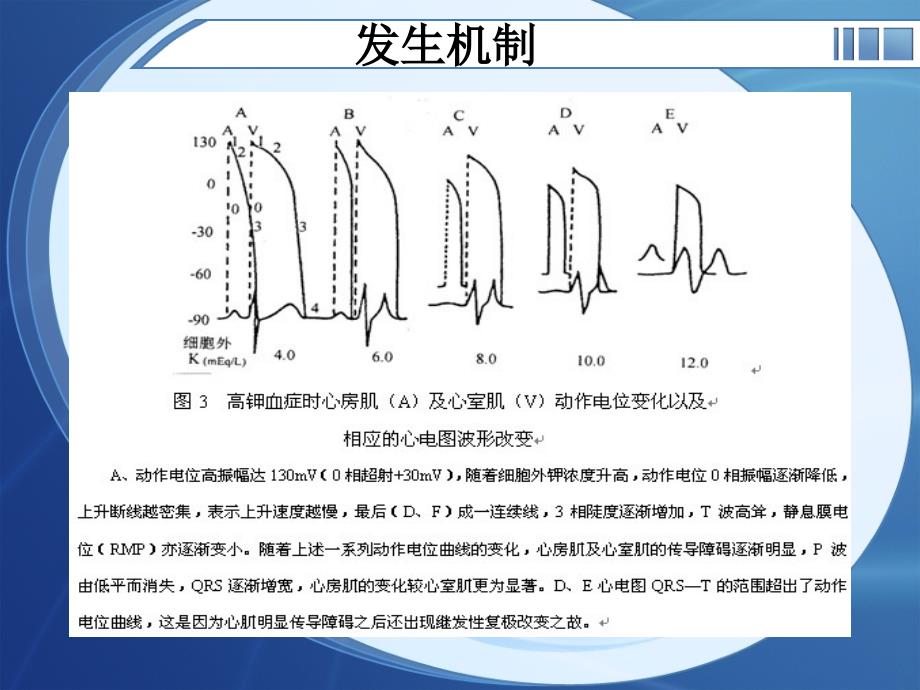 电解质紊乱心电图_第4页