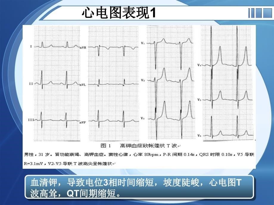 电解质紊乱心电图_第5页