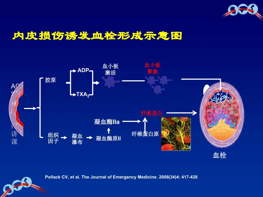 ACS抗栓治疗讲课_第1页