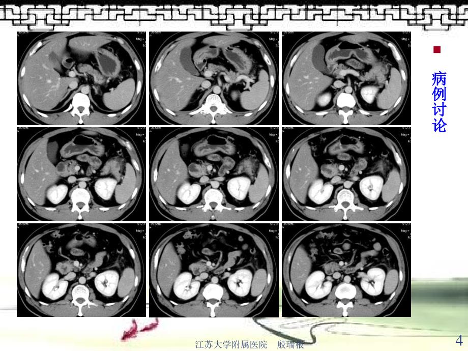 胰腺肿瘤及肿瘤样病变影像诊断_第4页