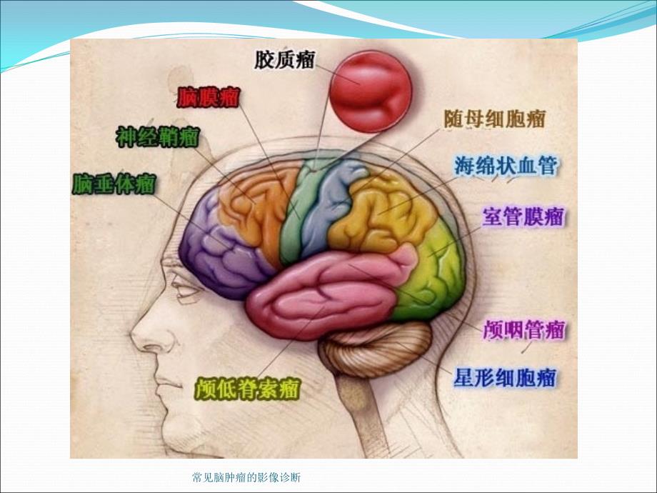 常见脑肿瘤的影像诊断课件_第3页