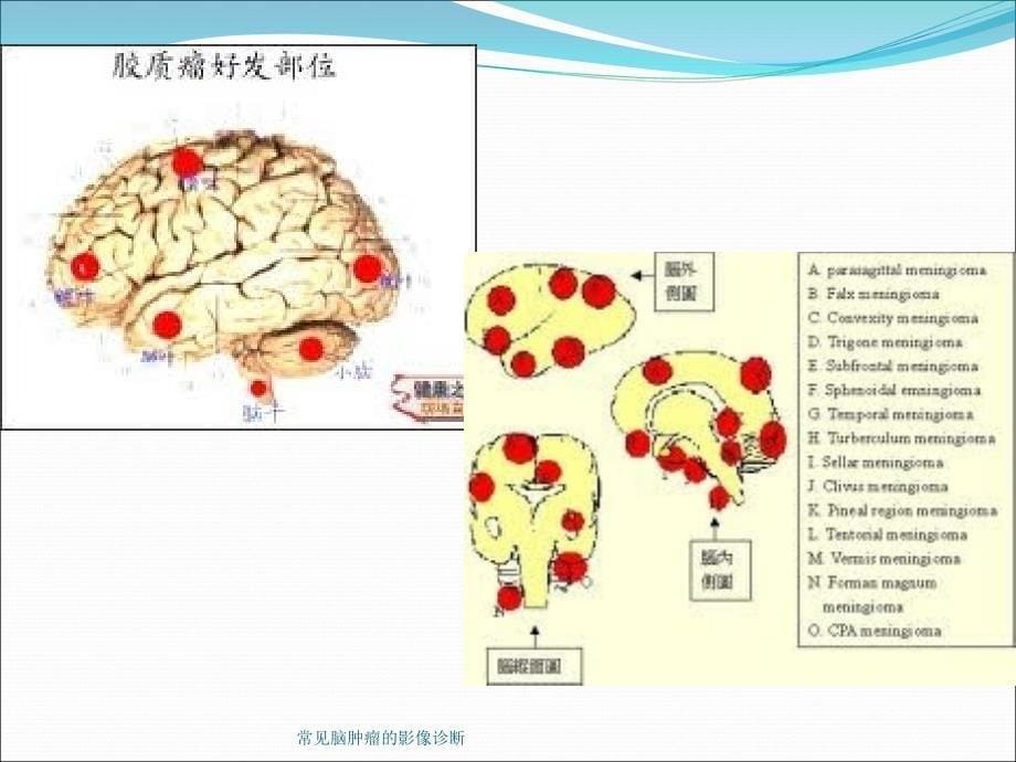 常见脑肿瘤的影像诊断课件_第5页