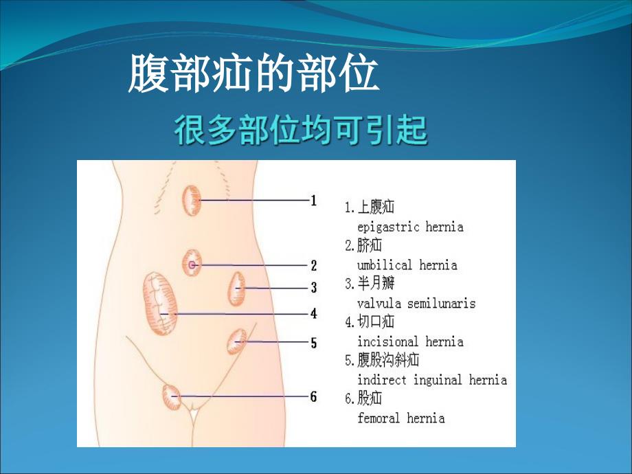 小儿腹股沟疝详解课件_第2页