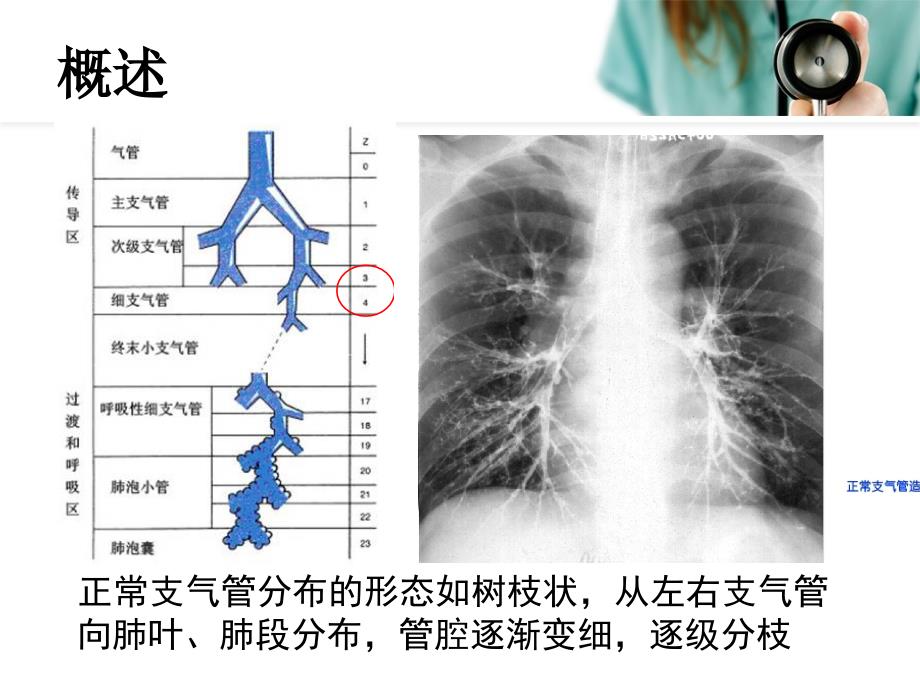 儿童支气管扩张Brochiectasis（业内荟萃）_第3页